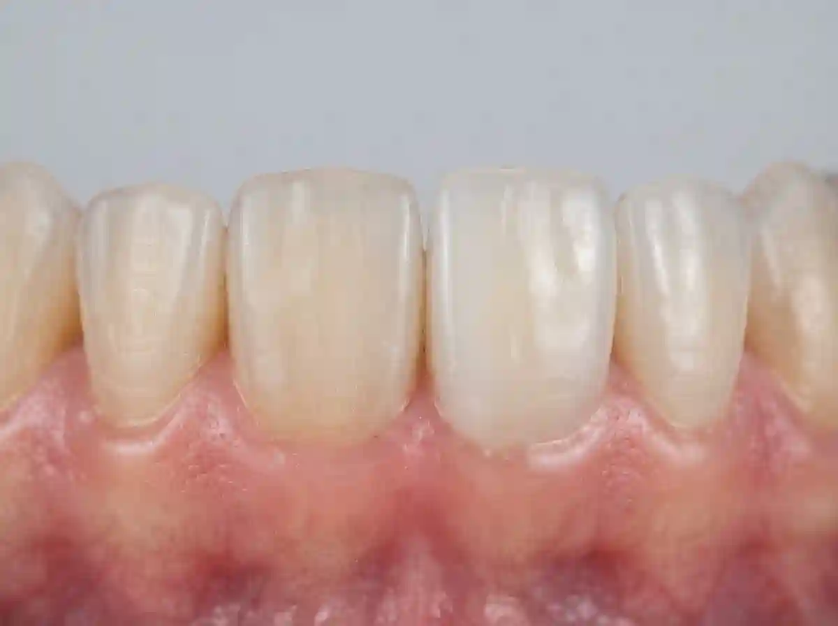 Focus Dental Bodrum Lamine Diş Kaplaması